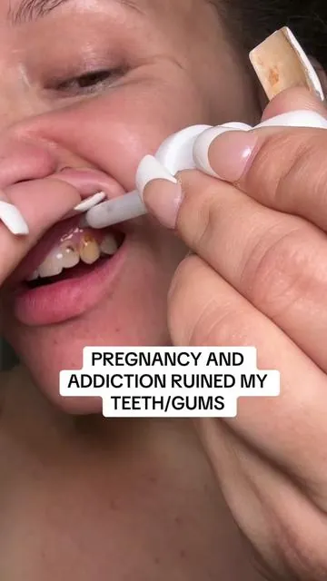 If you’ve got cavities, bad breath, or gums that just aren’t happy — Dentite Tooth Armor is the clean oral-care upgrade you need 🦷 Formulated with hydroxyapatite (the same mineral your enamel’s made of), it helps strengthen teeth, freshen breath, and support gum health without harsh chemicals or sensitivity. Think of it as skincare… but for your smile ✨ ✨ These are my opinions. Please check reviews, do your own research, and make informed decisions as results may vary!! I’m only sharing what’s helped me TREMENDOUSLY. #pregnancyproblems #oralhealth #Hydroxyapatite #GumHealth #OralCareRoutine 