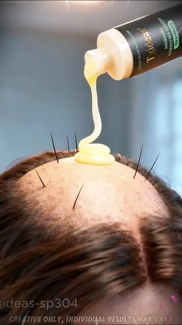 My doctor friend recommended a rosemary shampoo that's really good. If you have severe hair loss, you should definitely try it.#hair#hairtok#hairstyle#haircut#tiktokshopfalldealsforyoudays#TikTokShopBlackFriday #TikTokShopCyberMonday