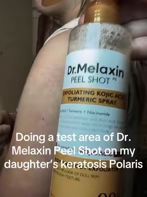 Exceeded our expectations! Looking forward to continuing the treatment tomorrow and will do an update. #peelshot #drmelaxin #keratosispilaris 