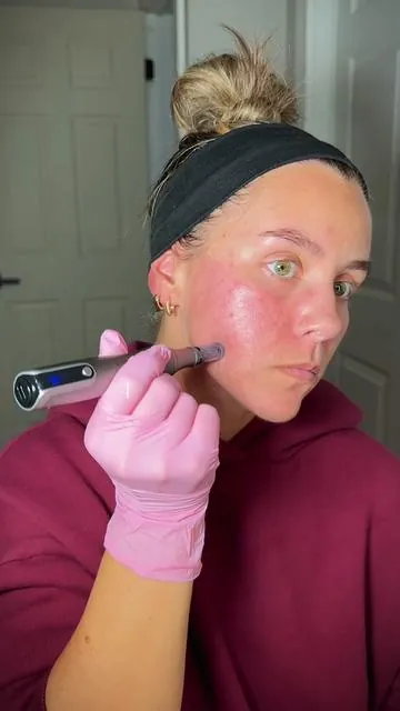 Round 2 Micro-needling at home as a total beginner 💉✨ Everything is linked👇🏼 here and also in my AMZ storefront! 💓 #microneedling #skintreatment #microneedlingface #tiktokshopblackfriday 