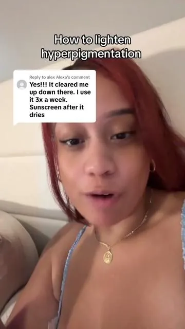 Replying to @alex Alexa how I lightened my hyperpigmentation #hyperpigmentation #darkspots #darkspottreatment #intimatelighteningtreatment #brightening 