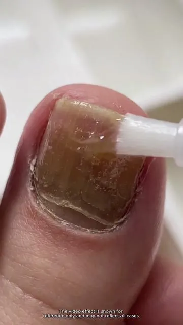 I Can't Believe Anyone Still Doesn't Know About This Gem!#toenailfungus #fingernailfungus #nailinfection #tiktokmademebuyit #tiktokshopblackfriday 