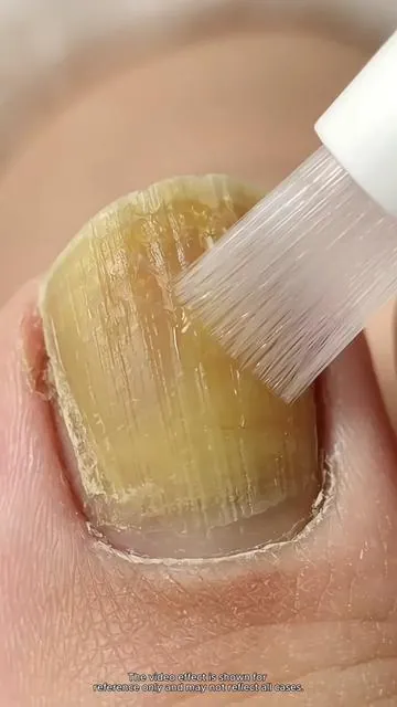I Can't Believe Anyone Still Doesn't Know About This Gem!#toenailfungus #fingernailfungus #nailinfection #tiktokmademebuyit #tiktokshopblackfriday 