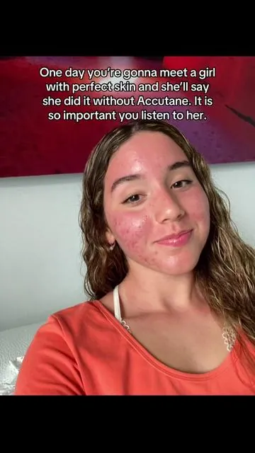 I’m so glad I listened to her #acne #skin #acnetreatment 