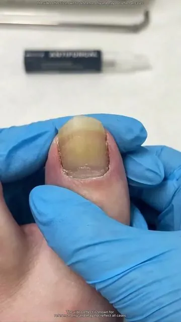 If you also encounter this situation, you can try this! #nailfungustreatment #healthynails #fungalnails #toecare #tiktokshopblackfriday