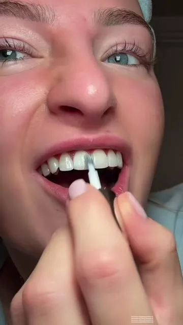 #gurunanda #teethwhitening #gurunandawirelesswhitening #whiteteeth #tiktokshopholidayhaul @GuruNanda LLC @Puneet Nanda bridge the gap  Video credit: @Elma Rebecca