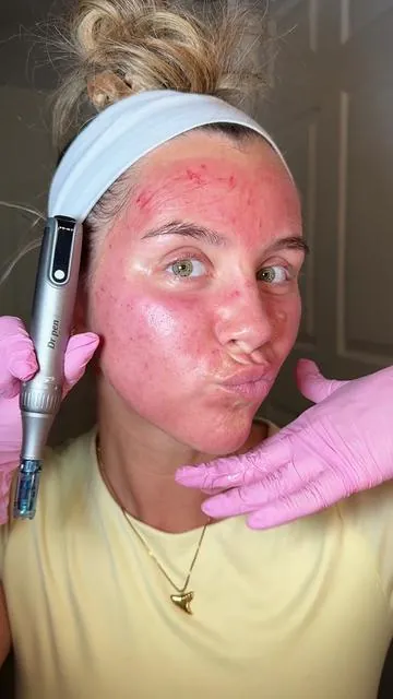 Microneedling step x step WITH my results at the end! 💉✨🫶🏼 Follow for more! #microneedling #drpen #acnescars #microneedlingface #skintreatments 