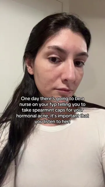 I have no more active acne!! She actually changed my life I don’t remember her page tho 😭 