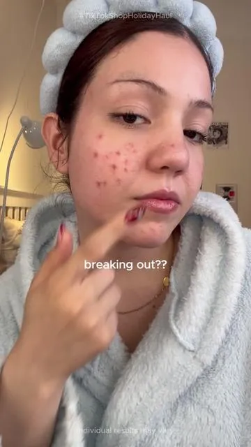 If you’re tired of covering, filtering, hiding… same here. Dr. Leo helped me feel less embarrassed about my skin.#tiktokshopholidayhaul #drleodryinglotion #salicylicacid #acnetreatment #breakout 