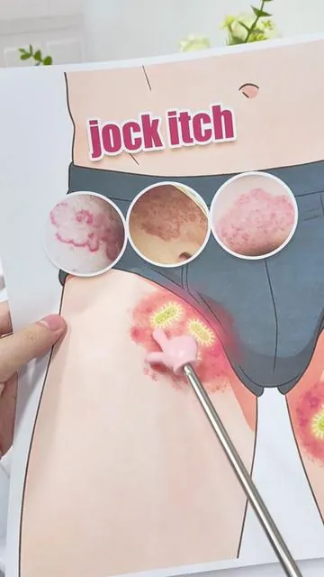 Brothers, if you have this issue in the groin area, you need to pay close attention!00 #jockitch #menshealth #skincare #fungalinfection #healthtok 
