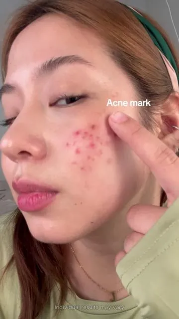 Dr.Leo's formula is so clean, even my sensitive skin loves it.#tiktokshopholidayhaul #acnetreatment #skincareroutine #drleodryinglotion #salicylicacid 