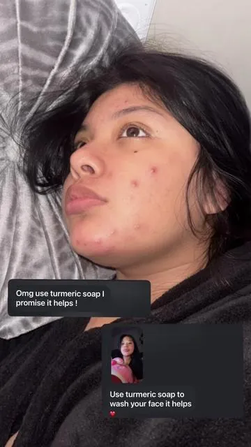 #turmericsoap #tiktokshopfinds #acne #fypシ 