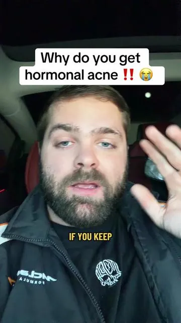 Once you realize how simple the process is, this becomes the simplest fix! #acne #hormonalacne #acnejourneytoclear #acnejourney #acnetips 