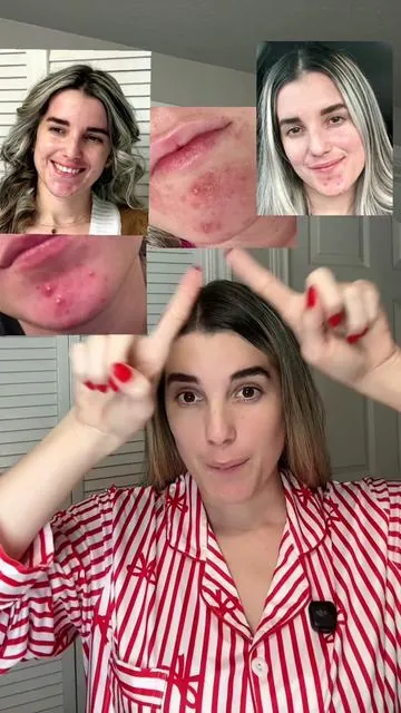 Respuesta a @Christy si tienes acné y manchas estos productos te van a ayudar @Dr.Leo-VN 