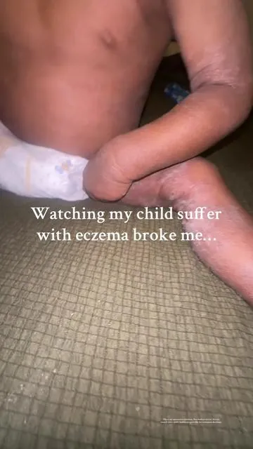 My sister kept sending me videos about Ocean Healed My Eczema cream on TikTok. I was skeptical, but eventually I tried it. For us, it became part of a routine that felt much gentler on his skin. Over time, his skin settled. He slept better. And seeing his smile come back meant everything. This is just our experience — but it’s been a meaningful part of our journey. #EczemaFlareUp #BabySkincare #eczemaawareness #MomStruggles #SkinHealth