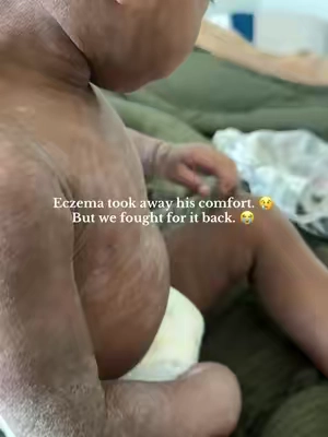 If you’re a mom dealing with eczema flares, tsw, or recurring yeast-related irritation from years of scripts … I see you 🤍 There comes a point where you just want gentle care, balance, and relief, not another cycle of harsh meds. This is the routine that’s been helping us during flares and sensitive seasons: • Lunavia eczema foam for daily comfort • Ocean helped my eczema as a moisturizer  • Castor oil or Aquaphor to seal in moisture If yeast or microbial imbalance is part of your struggle, using antifungal / antimicrobial-supporting ingredients (like tea tree oil–based washes) can be helpful for some, followed by zinc-based care to support the skin barrier. Every child and every body is different — this is simply what’s been supportive for us while choosing a more holistic, skin-first approach 🤍 ✨ From one mom to another: you’re not crazy for wanting answers beyond scripts. ⸻ This reflects our personal experience only. Not medical advice. What works for us may not work for everyone. Please consult your child’s physician or qualified provider before making changes. #holisticwellness #skincareroutine #skinhealth #eczemarelief #eczemaawareness 