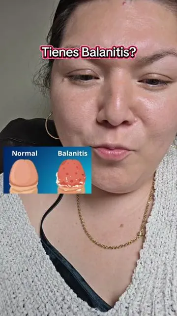 #tratamientodebalanitis #Balanitis 