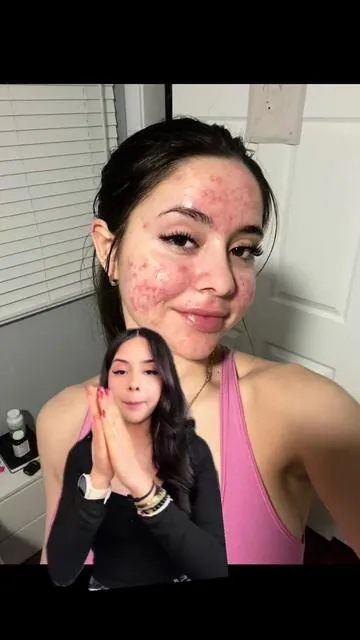 Para la rojez del acné 😍  #azelaicacid #anuaacneserum #acne #acnescars #greenscreen 