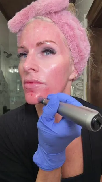 🔗 for microneedling pens (DR PEN)  in b i o #microneedlingface #microneedling #antiagingskincare #diyskincare #skintreatments 