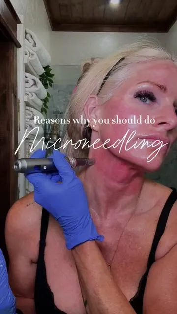 You don’t realize how much your skin needed microneedling… until you see the results. Texture smoother. Tone brighter. Collagen activated. This is the glow that actually shows up #microneedling #c#collagenboosta#antiagingroutines#skincaretipsover40skincare