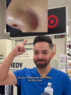 Sebaceous filaments hack!