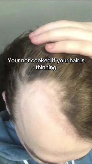 Grab the bundle on tiktok for a better price! #tiktokshopcreatorpick #hims #thinninghair #menhair 