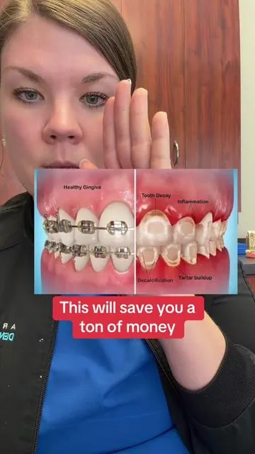 Easy way to keep your kid’s teeth beautiful and no decalcifocation. #TikTokShopCreatorPicks #tiktokmademebuyit #ortho #braces #oralhealth @Ceelike Oral Care 