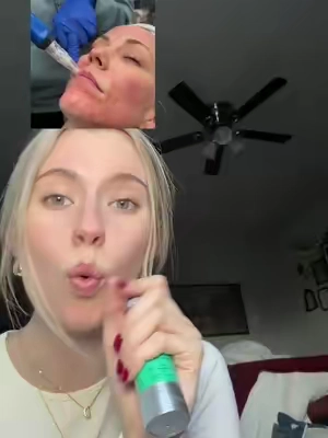These serums are INSANE and literally resurrected my skin, I’ve never felt so confident! Microneedling results at home! #microneedlingface #microneedlingtherapy #microneedling #microneedlingbeforeandafter #skincare 