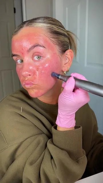 My 4th treatment at home 💉 as a newbie. Everything is 🔗’d in my bio! See my other vids below 👇🏼  ⁣ Post Treatment Product Favs 🤍  ⁣ @Prequelskin  • Glycerin Cleanser ⁣ • Am/Pm Modern Moisturizer ⁣ • Multi Quench Serum ⁣ • Redness Reform ⁣ @Naturium  • Dew Glow SPF 50 ⁣ @luyorsofficial  • Red Light Therapy Mask ⁣ ⁣ #microneedling #microneedlingface #microneedlingbeforeandafter #skincaretreatment #tiktokshopcreatorpicks @Ki Cosmetics ❣️