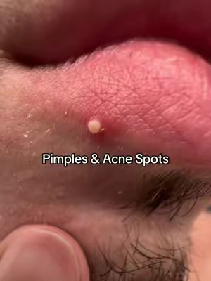 The OG pimple patch
