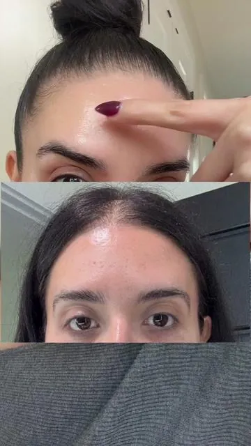 Forever grateful for this transformation #tiktokshopjumpstartsale #medicube #microneedling #pdrn #kbeauty 