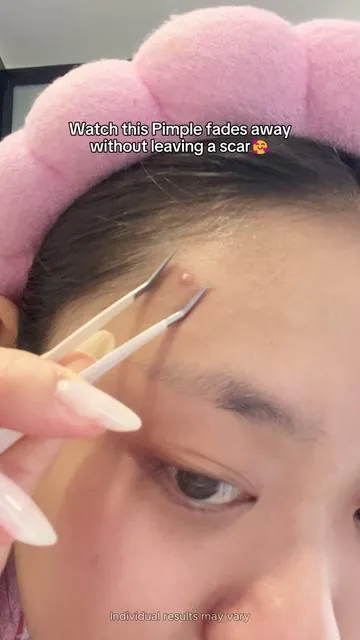 I’ll keep it around🥰#skincareroutine #drleodryinglotion #acnescars #glowuptips #glassskin 
