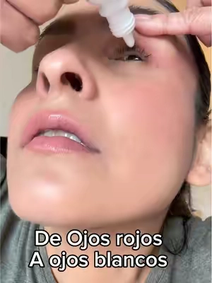 #rednessrelief #ojosrojos 