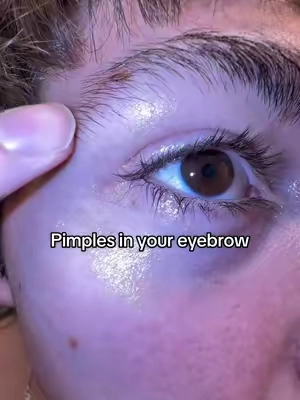 The OG pimple patch