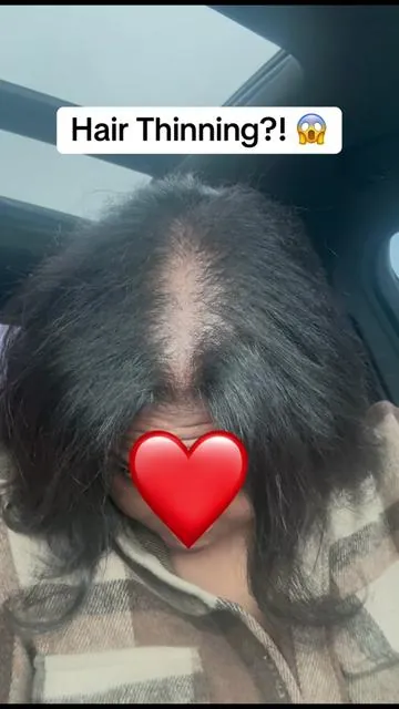 I was so insecure about my hair lately… this helped more than I expected 🥺  #hairgrowth #maryruthsorganics #haircare #hairjourney #hairloss 