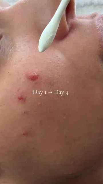 When it comes to my daughter’s skin, I’m extra cautious. We focused on keeping things simple, targeted, and consistent — just spot-treating what actually needed attention and paying attention to how her skin felt, not chasing overnight results. Watching redness look calmer over a few days — without irritation — gave me peace of mind more than anything. Sharing this for other moms who move slowly and intentionally with skincare 🤍 (Always patch test and do what feels right for your family.) @Dr.Leo-USA 