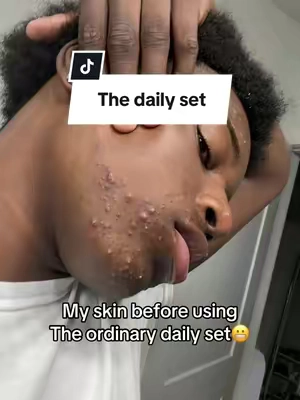 The results speak for itself after 2 months it really healed my skin a lot #skincare #theordinary #skincareroutine #acne #theordinaryskincare 
