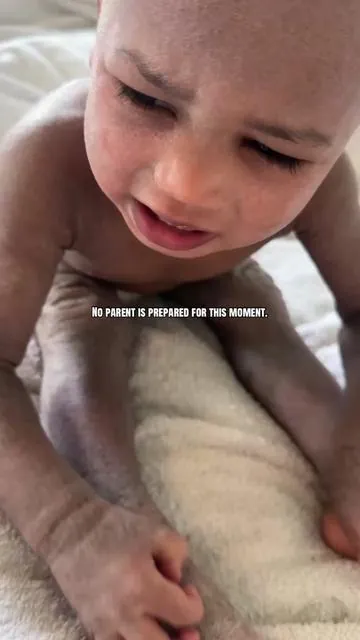 Eczema is a battle my baby didn’t choose… but one we face together every single day. Watching him scratch, hurt, and try to understand what his little body is feeling breaks me in ways words can’t explain.  As a mother, I can’t fix everything — but I can comfort him, hold him, and care for his delicate skin the best way I know how. Sometimes it’s not about perfection… it’s about peace, routine, and small moments of relief that mean everything to us. 🤍 To every parent walking this sensitive skin and eczema journey — you are not alone. ⸻ #Ecz#Eczemat#MotherhoodMomentsn#SensitiveSkina#RealMomLifea#HealingThroughLove