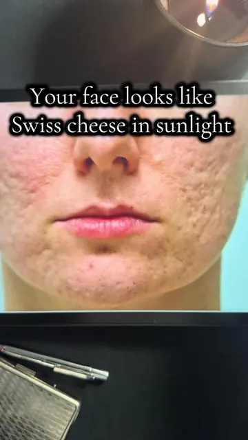 This Korean skincare routine is like Microneedling in a bottle. Summer is coming up and this will help revive your glow. #glasskin #acnetreatment #microneedle #acnescars 