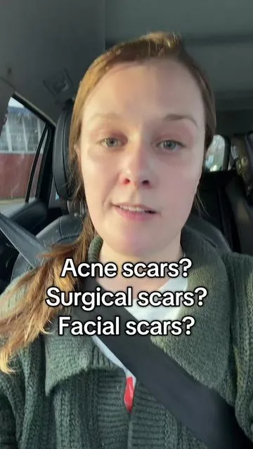 Scars don’t heal on their own- but medical grade silicone can greatly help fade them! Prequel has a scar stick that fades scars- go read the reviews!! #prequel #scarstick #scarsolutions #tiktokshopcreatorpicks #prequelskin 