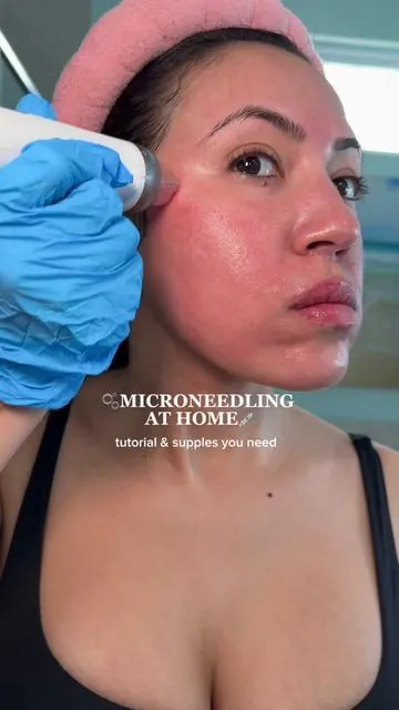 Microneedling 101 for my girlies on a budget ✨ Everything is linked in my bio 💕 #microneedling #microneedlingbeforeandafter #skintreatments #glowyskin 