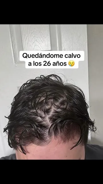 #hairgrowth #transformation #antesydespues #paratii 