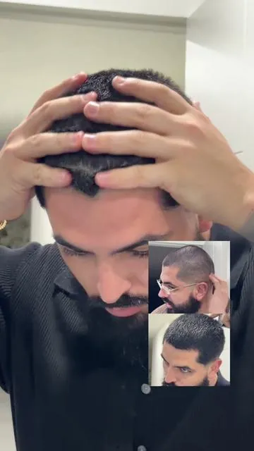 El secreto no es tener mas cabello sino tener mejor densidad 👇. • el nanoxidil 7% estimula el folículo y prolonga la fase de crecimiento ayudando a mejorar densidad y grosor. • Reactiva folículos miniaturizados y fortalece el cabello debilitado. • Ayuda a contrarrestar el efecto de la DHT sobre el folículo . • Se usa 1–2 veces al día, siempre con constancia todos los días . • para potenciar aún más los resultados controlar el estrés, comer suficiente proteína y mantener el cuero cabelludo limpio. #hairgrowth #hairtransformation #hairgoals #nanoxidil #dhtblocker 