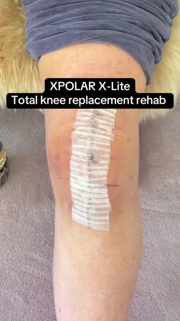 Total knee replacement surgery, rehab, icing, and controlling inflammation is the most crucial thing #kneereplacement #recoveryjourney #kneerehab #xpolar 