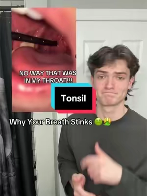 Fix that breath to 🤢🤮 #tonsilstones #badbreath #dental 