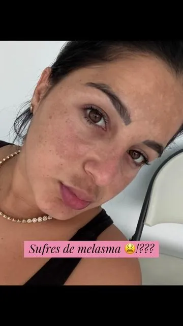 Esta es mi rutina de día, la que tanto me ha ayudado con mi Problema de melasma ,yo amo este set!!!! #melasma #melasmatreatment #melasmaskincare #medicube #skincarededia 