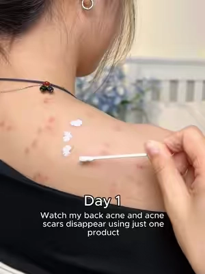 If you're also struggling with back acne, this might be able to help you. #drleodryinglotion #drleohonestreview #acnetreatment #skincareroutine #acne 