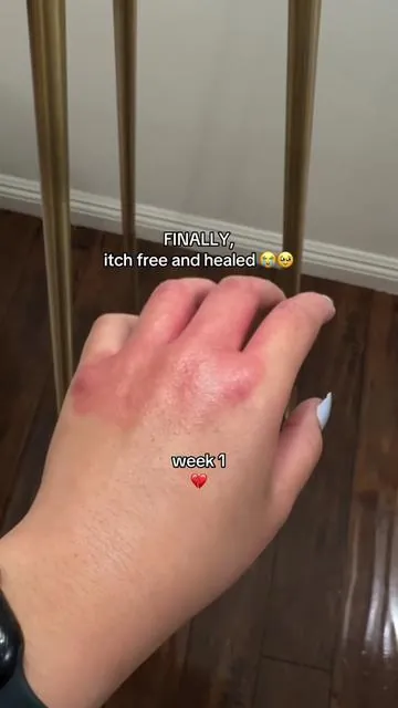there’s a reason they had a waitlist for this launch 😮‍💨 #dryskin #eczema #prequel @Prequelskin 