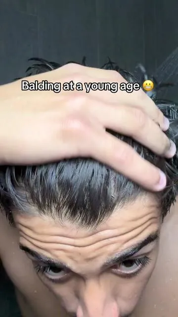 Keep your hair from thinning! #hims #hairloss #balding #shampoo #hairgrowth 