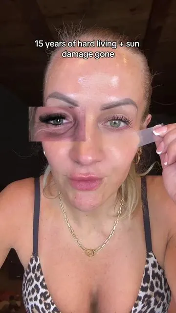 Sun damage, hyperpigmentation, clogged pores, textured skin, fine lines, wrinkles, and hollow under eyes is exactly why I wanted to try the Dr Melaxin Radiant Blowout Routine Set. With kojic acid, a melanin inhibitor, calcium, Rebornic, and a spicule serum, this routine targets discoloration, pores, texture, and signs of aging in one routine. #drmelaxin #radiantblowoutroutine #hyperpigmentation #largepores #texturedskin 